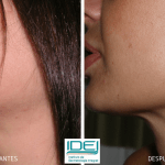 tratamiento-para-eliminar-marcas-de-acne-fotos