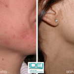 fotos-antes-despues-tratamientos-eliminar-marcas-acne