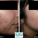 adios-a-las-marcas-de-acne-fotos-antes-despues