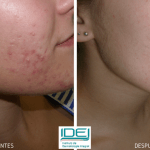 elimina marcas de acne con estos tratamientos