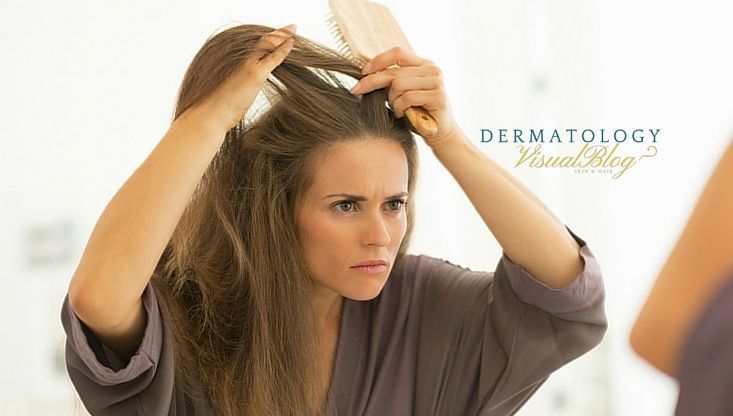 Tengo-caspa-o-dermatitis