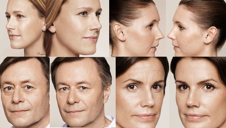 restylane-skinbooster-acido-hialurónico-1