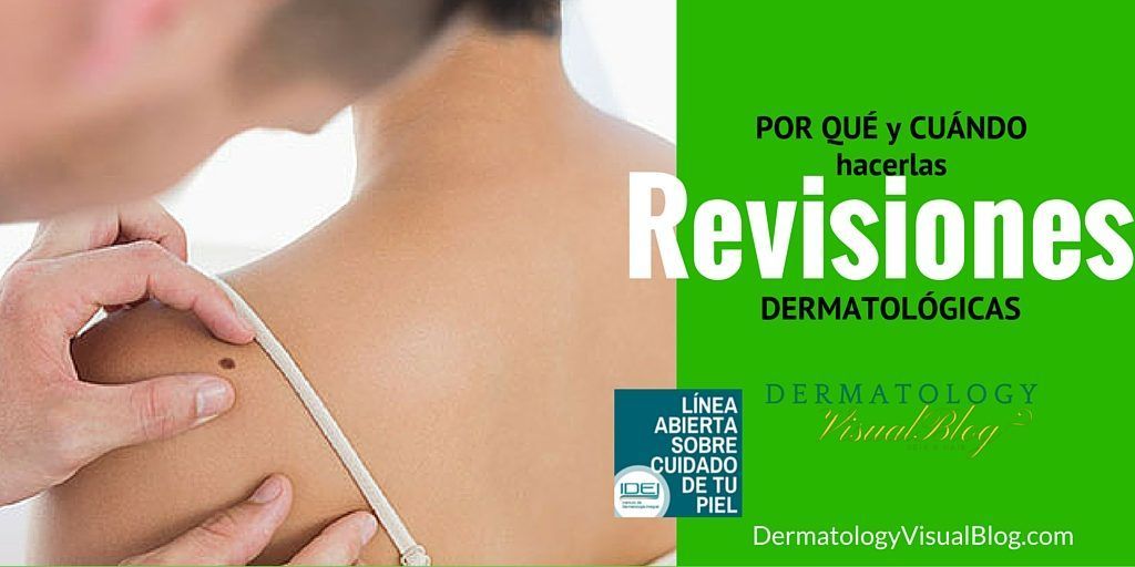 Revisa tus lunares contra el melanoma