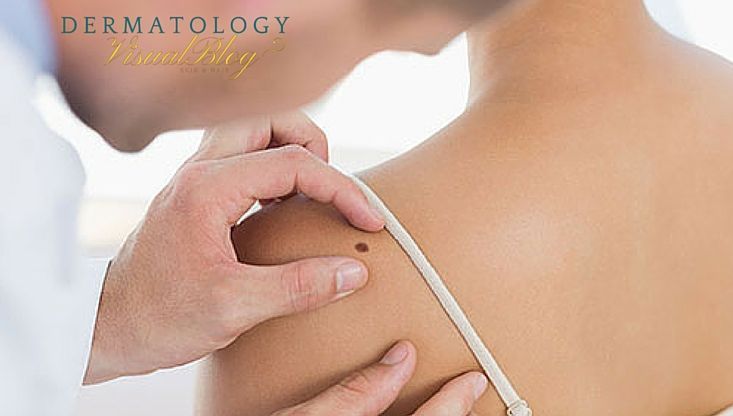 Revisiones dermatológicas- por que y cuándo hacerlas