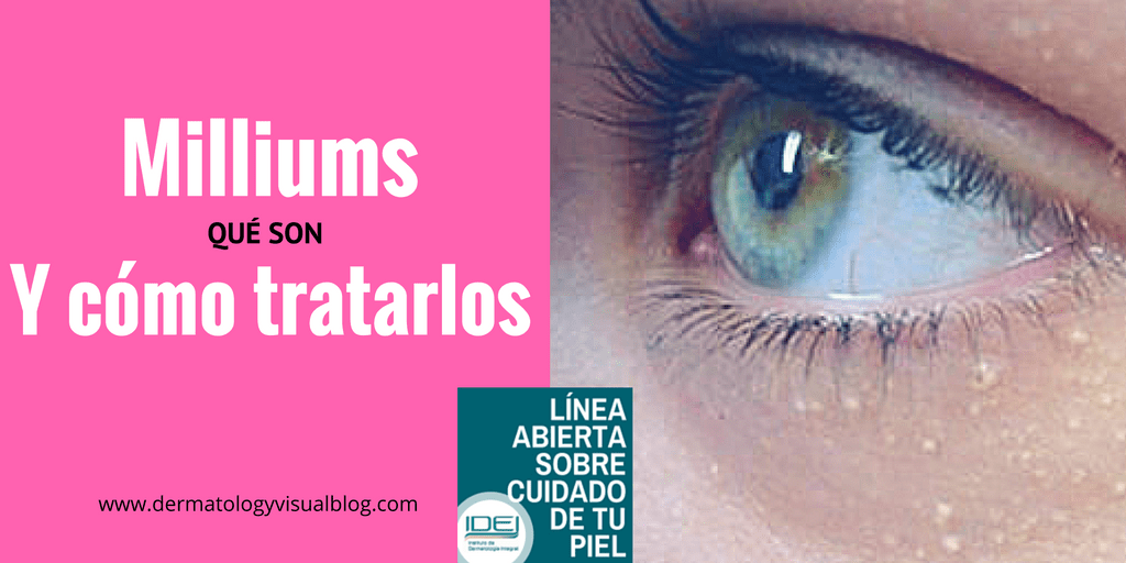 tratamiento-dermatologico-para-milliums