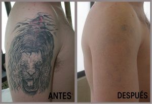 foto antes y despues eliminacion tatuajes