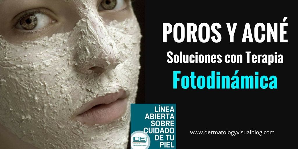 Terapia Fotodinámica para tratar el acné