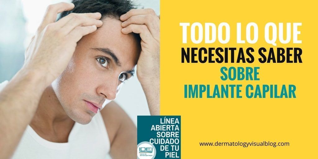 QUE ES UN IMPLANTE CAPILAR