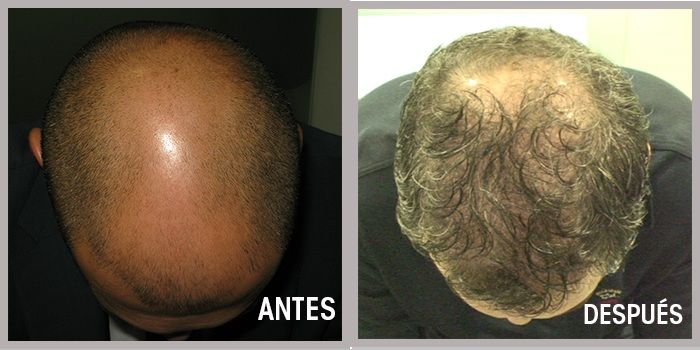 implante antes y despues