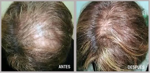 implante-antes-y-despues-idei