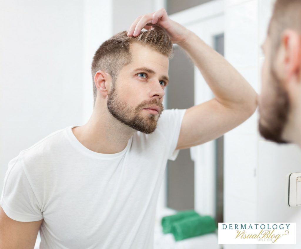 los hombres calvos tienen más testosterona