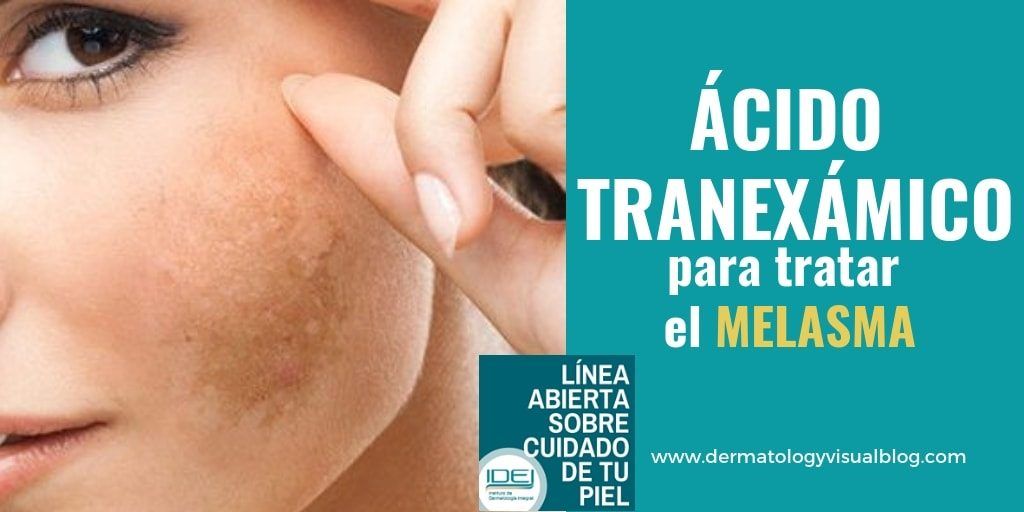 acido tranexámico para trar el melasma