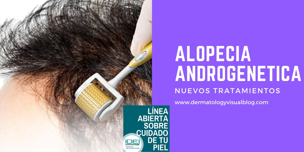 alopecia androgenética nuevos tratamientos