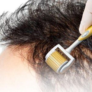 microneedling_capilar