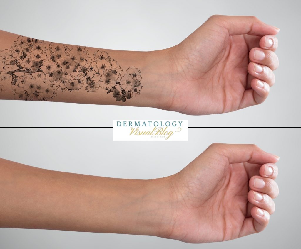 Método más efectivo para la eliminación de tatuajes