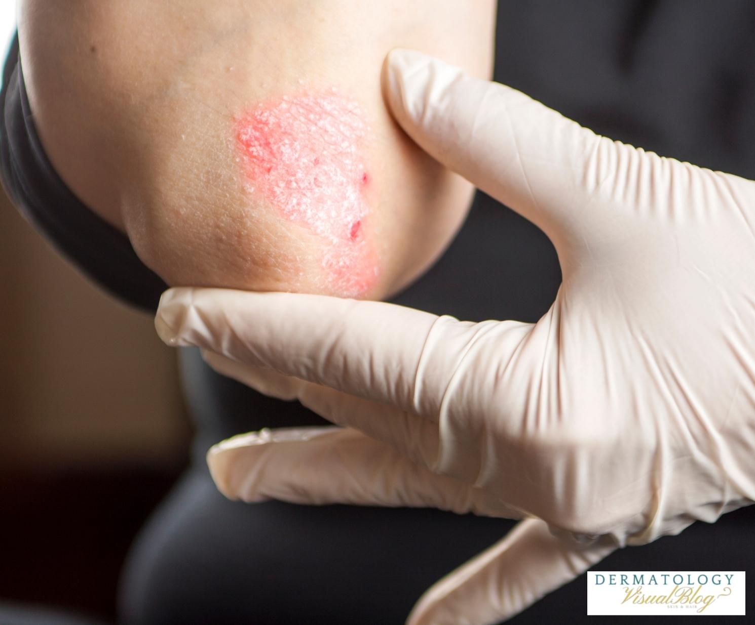 La psoriasis es hereditaria